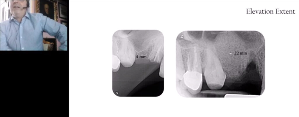 Minimally Invasive Management of Implant Supported Rehabilitation in the Posterior Maxilla IPA
